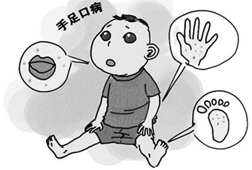 济宁市疾控中心提醒:麻疹风疹手足口病进入高发季
