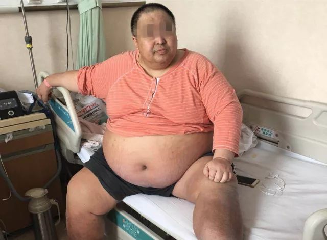 惊了！440斤大叔来青岛缩胃减重，住院期间压坏3张床垫…