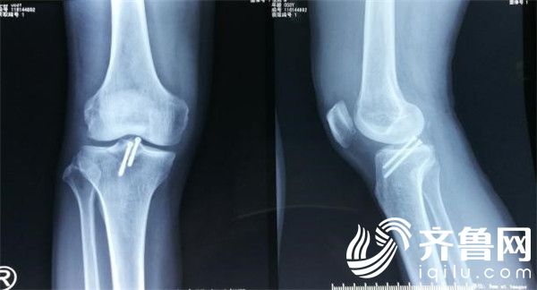 烟台山医院完成国内首例胫骨髁间隆突骨折机器人手术