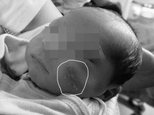剖腹产手术中医生失手 宝宝刚出生就遭毁容(图)