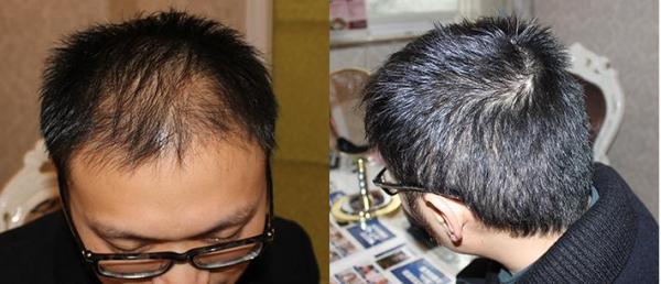 杭州植发医院排名_植发医院排名质丽网