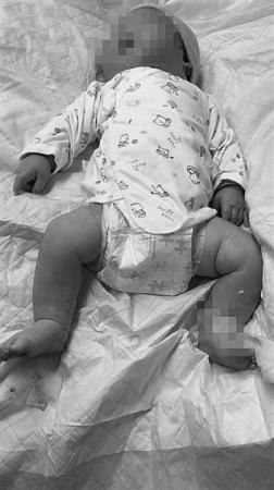 201斤产妇剖宫生了个12斤巨婴