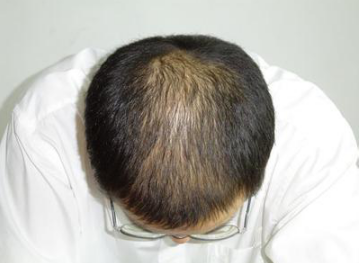 治疗脂溢性脱发?这个处方屡试屡灵