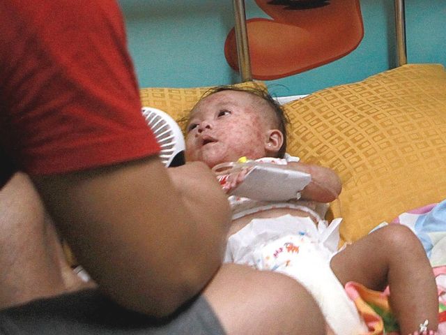 菲律宾多地暴发麻疹疫情 上月至少25人死亡
