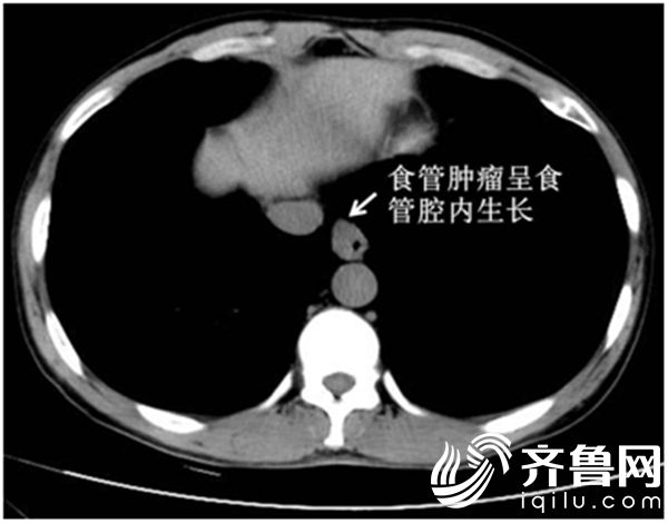 胸部增强CT提示食管肿瘤呈食管腔内生长