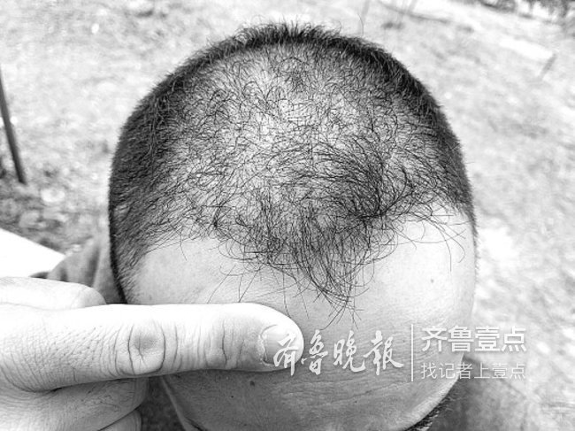 济南男子花一万五植发却患上毛囊炎 店家:头发还在长