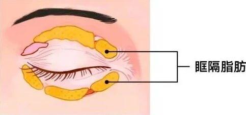 卧蚕是怎么弄出来的 1556442193944.jpeg