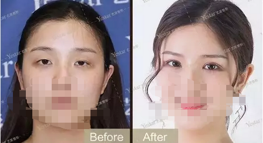 开眼角一般价格表 1560134105784.png