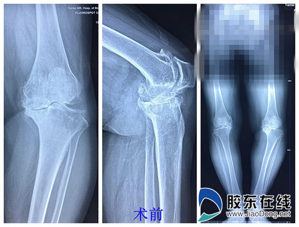 滨医烟台附院为七旬老人行复杂膝关节置换 术后2天即下床