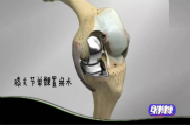 60岁老人换完膝关节接着就能下地，怎么做到的？