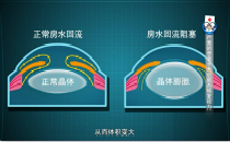 80岁以上的老人白内障患病率逼近100%！