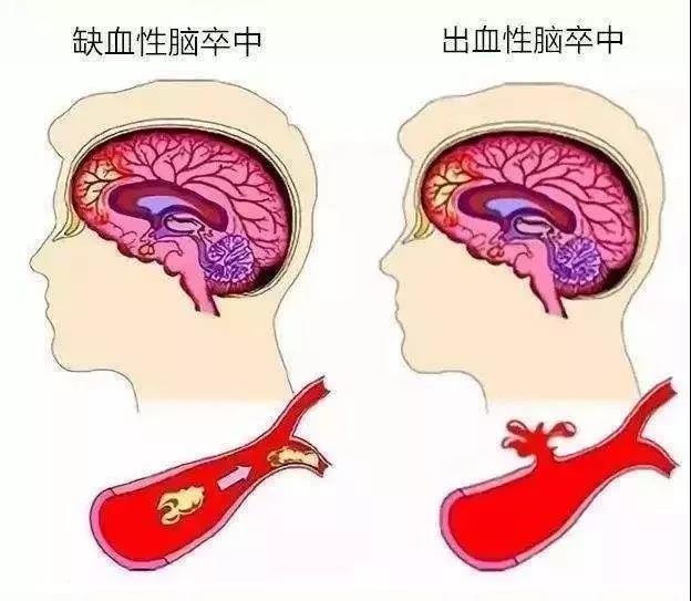身体健康 健康要闻脑卒中分为缺血性脑卒中和出血性脑卒中,是由于大脑