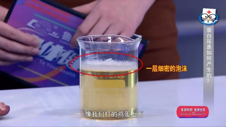 小便浑浊或出现大量泡沫:尿蛋白是糖尿病肾病的一个重要症状,大多数的