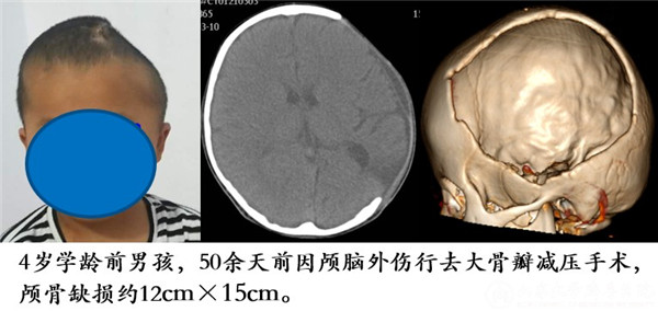 既往体健,入院查体提示头颅畸形,左侧额颞顶部颅骨缺损,入院完善颅脑