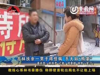 吉林扶余一男子得怪病 手大如”熊掌“
