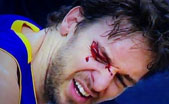 NBA球星扎堆挂彩：加索尔眼角撞破波什嘴唇缝了八针