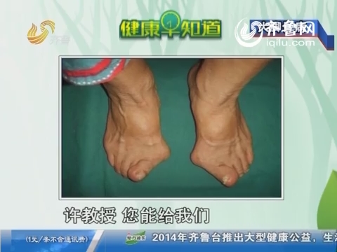 20140218《健康早知道》：大脚骨病