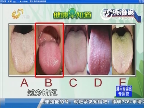 20140328《健康早知道》：舌头辨健康