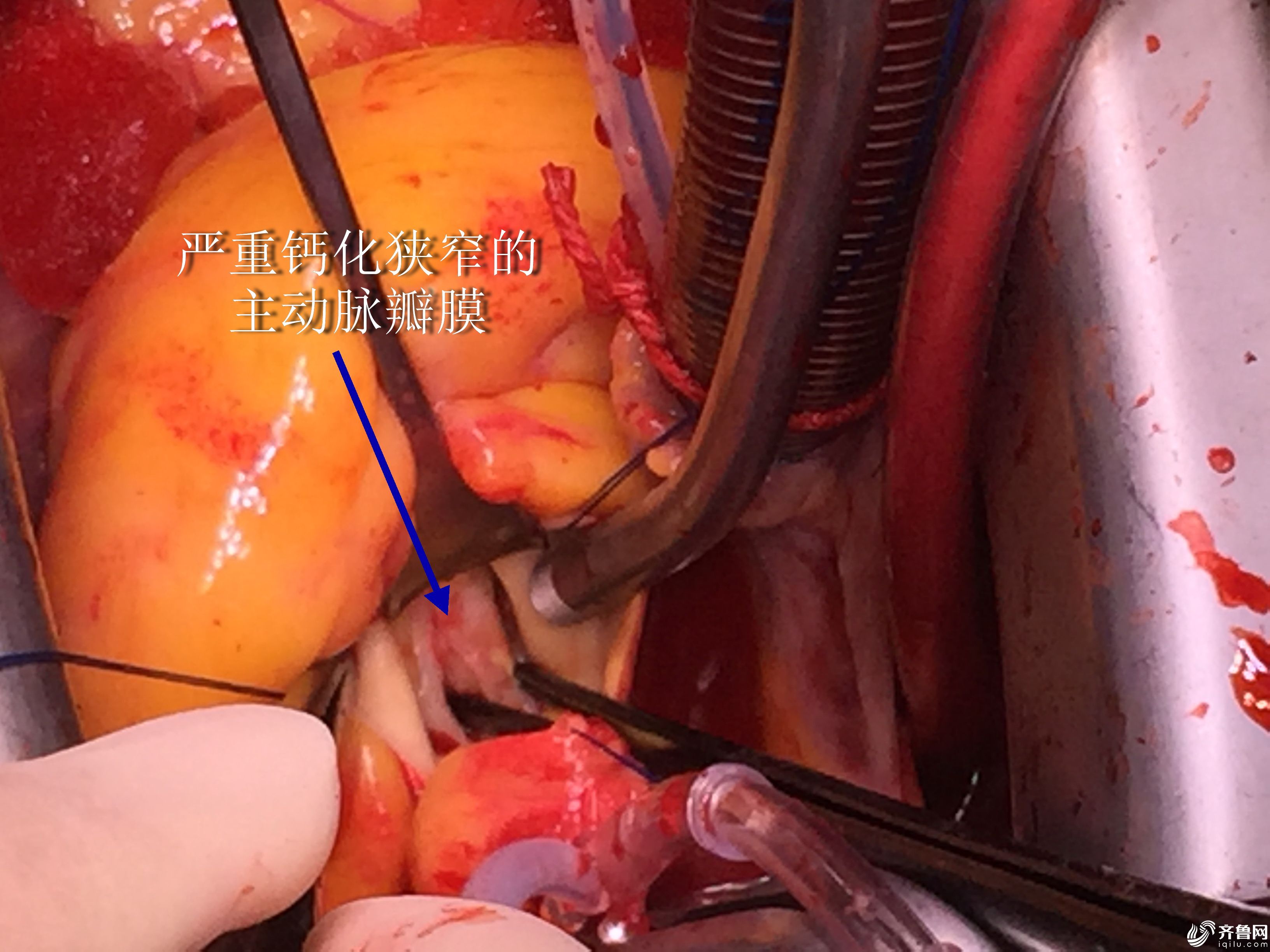 主动脉瓣膜已经发生器质性病变,不可逆转,建议尽早行心脏瓣膜置换手术