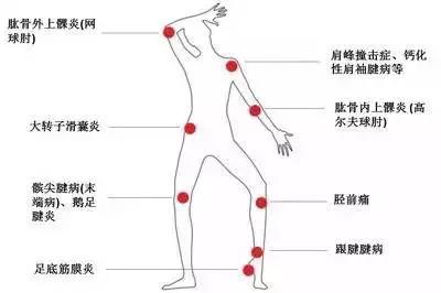 大转子走路疼图片