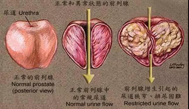 不良習慣會誘發前列腺增生