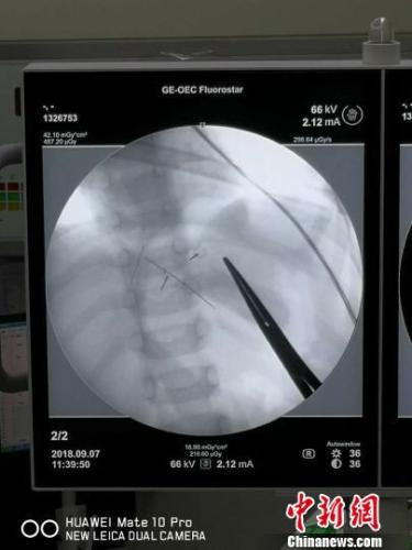 江西一男童肝臟內(nèi)發(fā)現(xiàn)繡花針 已生銹斷裂成五段