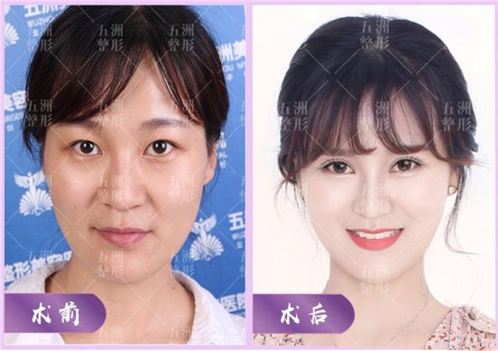 武汉五洲整形医院:PARK翘睫美瞳术,定制术式打造年轻美眼_保健_健康科普_健康_齐鲁网