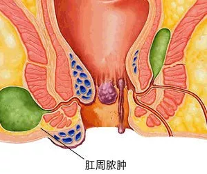 武汉东大肛肠医院:你的肛门有"小馒头"吗?当心了