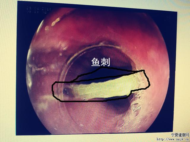 惊险 45岁男子被鱼刺卡住食管