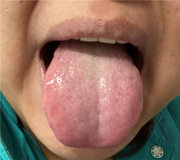 患者中藥1天后舌象