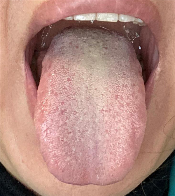 患者中藥半月后舌
