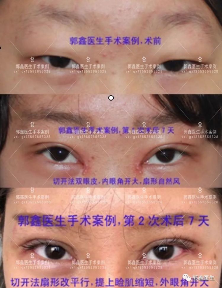 八大处整形郭鑫:全切双眼皮提肌缩短和提肌一样么