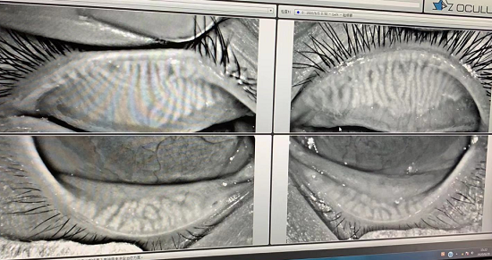 圖注:眼睛疲勞,眼睛乾燥,眼睛幹癢,小王的瞼板腺檢查結果
