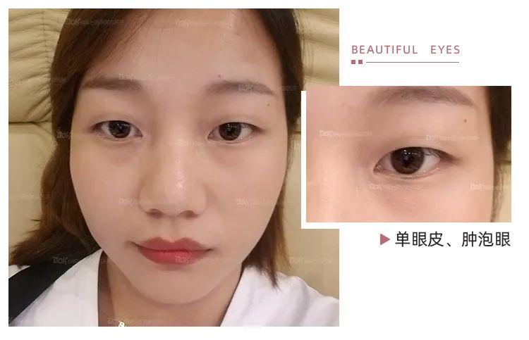 如果你眉眼距较宽,眼皮又薄薄的没有什么脂肪,那么就比较适合宽一点的