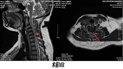 有圖有真相神經根型頸椎病在這裡康復